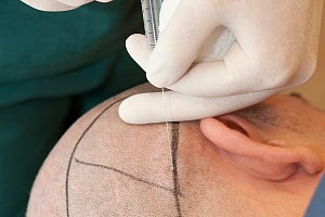 Программы по пересадке волос в отеле Rixos Downtown 5* & Клиника MedWorld, Анталья Программы по пересадке волос в отеле Rixos Downtown 5* & Клиника MedWorld, Анталья